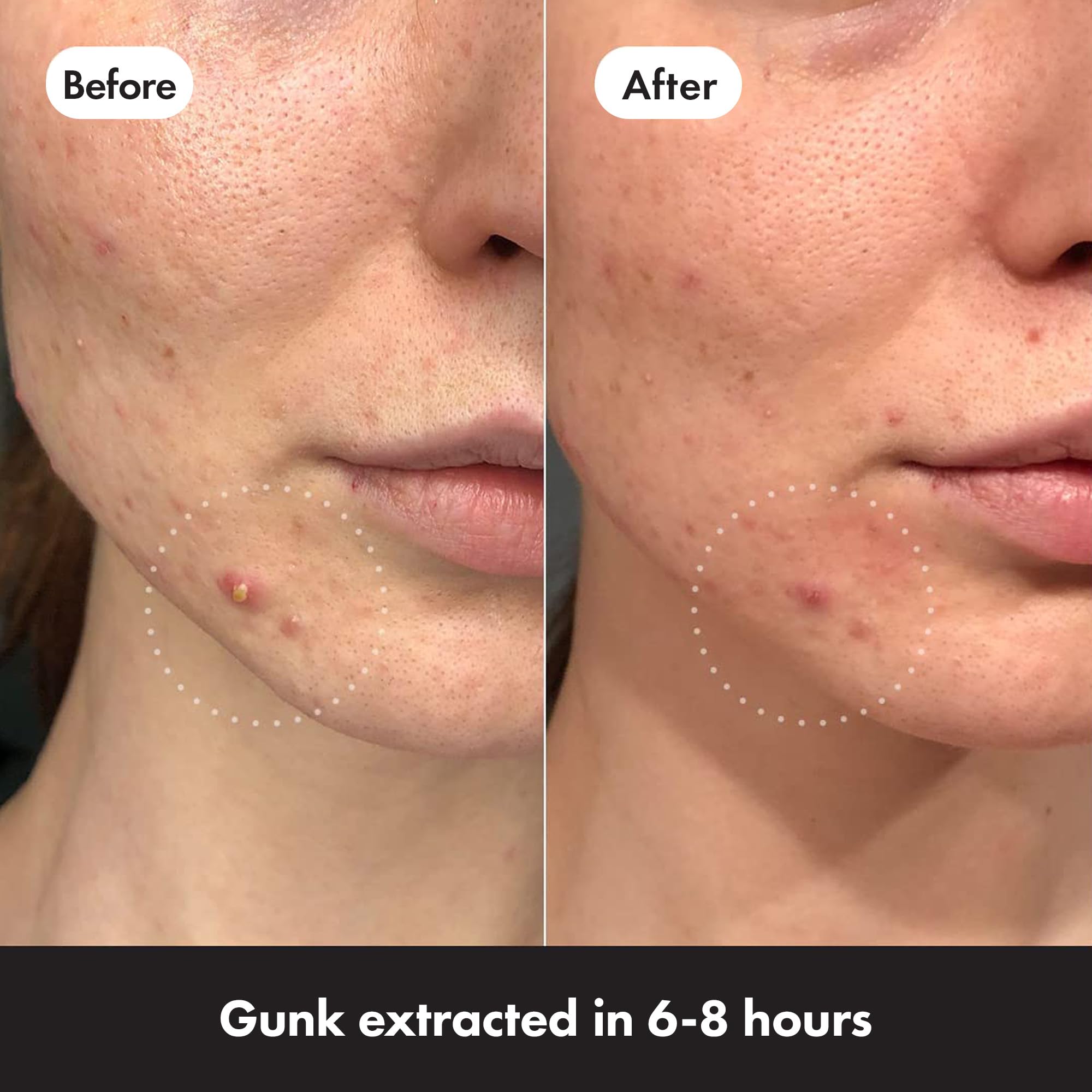 Hero Cosmetics - Mighty Patch Invisible+ Acne Patches (39 Count) 4