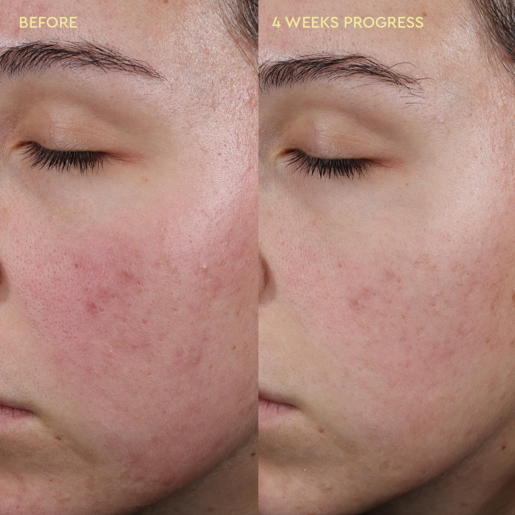 BYOMA Blemish Control Moisturiser (50ml) - Oil-Free, Ultra-Lightweight Moisturizer with Salicylic Acid for Acne-Prone Skin 9